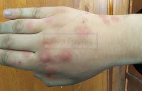 В немецком, нидерландском и датском борщевик называют «медвежьей лапой» (нем. bärenklau, нидерл. berenklauw, дат. Borshevik Ozhogi Simptomy Posledstviya I Lechenie