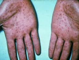 Early treatment is vital to prevent complications. Syphilis Dermnet Nz