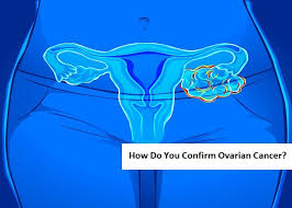 Quickly feeling full when eating. What Is An Ovary Types Of Ovarian Cancer Jioforme