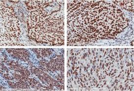 One of the first things that people want to know is the expected survival rate, according to asco. Mismatch Repair Protein Defects And Microsatellite Instability In Malignant Pleural Mesothelioma Journal Of Thoracic Oncology