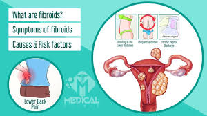 What Are Fibroids Fibroid Symptoms Causes Risk Factor For Women Fibroids Fibroids Symptoms Risk Factors