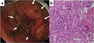 In the united states, bowel cancer—also called colon or colorectal cancer—is the third most common form of cancer in both men and women (excluding skin cancer). Pathological Complete Response Of Locally Advanced Colon Cancer After Preoperative Radiotherapy A Case Report And Narrative Review Of The Literature Surgical Case Reports Full Text