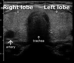 Fortunately, it is becoming easier to diagnose the disease through different technologies, with ultrasound imaging as one of the frequently used diagnostic tools.here we show somebreast cancer ultrasound images and important facts for your information. Thyroid Ultrasound