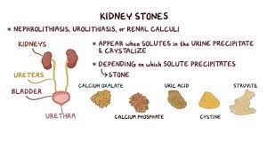 Kidney Stones Clinical Practice Osmosis