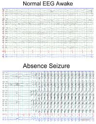 Image result for Absence Seizure
