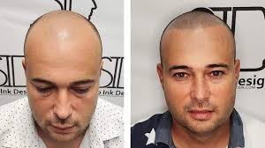 Before and After Photos of Scalp Micropigmentation (SMP)
