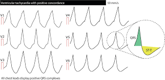 Typical ecg findings with examples of monomorphic vt. Ventricular Tachycardia Vt Ecg Criteria Causes Classification Treatment Management Ecg Echo