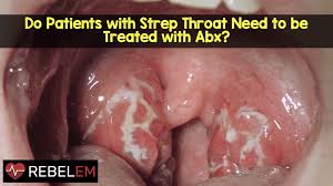 Do Patients With Strep Throat Need To Be Treated With Antibiotics Rebel Em Emergency Medicine Blog