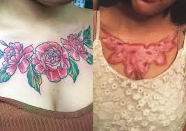 If you have worn it for six hours or more, sanitizer or rubbing alcohol is a better option for a less painful complete removal of the tattoo. Thai Student Suffers Painful Scars After Non Laser Tattoo Removal Treatment Asia News Asiaone