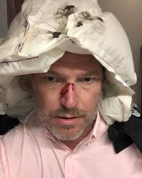 After more than 3000 stunt tests we had an involuntary test by our Sales  Manager Per yesterday. Some confusion in traffic and a steel beam resulted  in an inflated Hövding 3 but