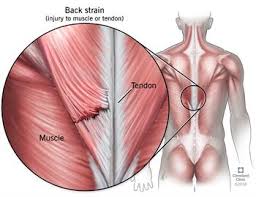Lower back muscle and hip pain may also be caused by stenosis in the spine. Back Strains And Sprains