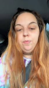 Acromicric Dysplasia