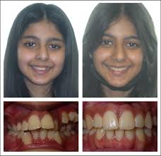 How To Fix A Canted Smile | Tiktok
