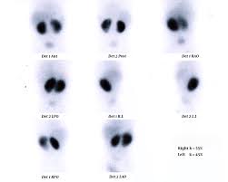 Dmsa is the common name for dimercaptosuccinic acid, also known as dimethylsuccinic acid, or disodium monomethanearsonate. Tc 99 Dmsa Scan Of An 8 Month Old Girl Left Kidney Has Normal Size Download Scientific Diagram