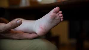 Nah ini dia nih motif henna kaki, jadi membuat henna itu enggak mesti di tangan. Penyakit Hfmd Pada Anak Apa Yang Ibu Bapa Wajib Tahu Theasianparent Malaysia