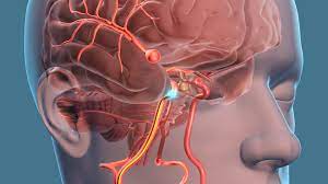 Brain Aneurysm Treatment Market 2018 Overview Of Growth Factors With Latest  Development And Trends 2023 | Medgadget