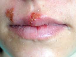 Herpes type 2 is believed to be a painful and dangerous infection that affects people. Herpes Skin Rash Symptoms Identification And Treatment