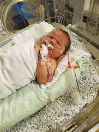 Cri du chat syndrome, also known as chromosome 5p deletion syndrome, 5p minus syndrome or lejeune's syndrome, is a rare genetic disorder due to a missing part of chromosome 5. Our Little Cri Du Chat Baby Is Here January 2020 Birth Club Babycenter Canada