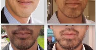 The article also mentions more side branching in breast ducts, possibly resulting in differences in how breast tissue works. How To Grow A Beard As Asian Without Minoxidil Lifestyle