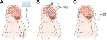 Signs of brain tumor in children. Frontiers Car T Cell Therapy For Pediatric Brain Tumors Oncology