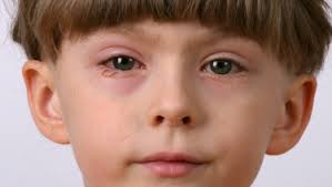 Do I Need To Keep My Son Home If He Has Pinkeye Healthychildren Org