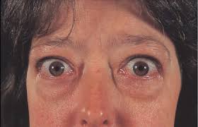 It frequently results in and is the most common cause of hyperthyroidism. References In Graves Disease The Lancet