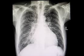 Image result for Chest XRay Interpretation