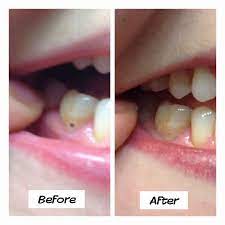 Brooke And Michael Essential Oils For Kids Best Toothpaste For Cavities Getting Rid Of Cavities Naturally