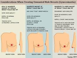 Causes of breast cancer dimpling are as follows. What Is Gynecomastia Medtalk