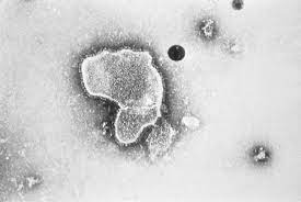 Bebês prematuros (nascidos antes das 29 semanas de. Infeccao Pelo Virus Sincicial Respiratorio Sintomas Diagnostico E Tratamento Bmj Best Practice