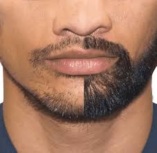 Maybe you would like to learn more about one of these? Is A Beard Hair Transplant Surgery Painful Cyber Hairsure