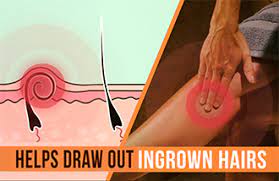 Will drawing salve work on ingrown hair. Ingrown Hair Drawing Ointment Ingrown Hair