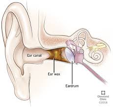 There are plenty of possible causes for a blocked ear: Earwax Blockage Symptoms How To Remove Clean