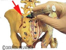 Image result for Joint Injection