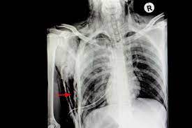 Subcutaneous Emphysema: Symptoms, Causes, And Treatment