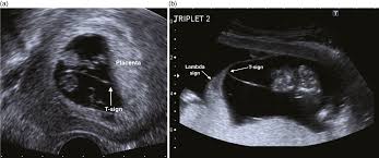 One issue with anonymous classes is that if the implementation of your anonymous class is very simple, such as an interface that contains only one method, then the syntax. Pregnancy Ultrasound For Srh Work Chapter 7 Ultrasound In Reproductive Healthcare Practice