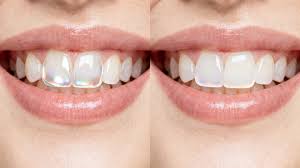Porcelain Veneers vs Composite Veneers: Which Is Best for Sydney Smiles?