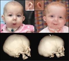 A Human Homeotic Transformation Resulting from Mutations in PLCB4 and GNAI3  Causes Auriculocondylar Syndrome