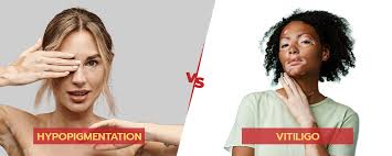 Image result for Postinflammatory Hypopigmentation