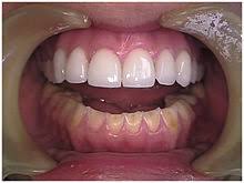 Die bulimie kranken die wirklich schlank sind haben meist vorher auch an magersucht gelitten. Bulimie Wikipedia