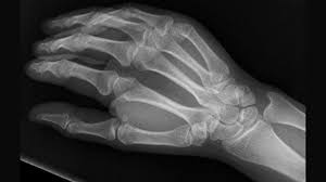 Image result for Hand Fracture