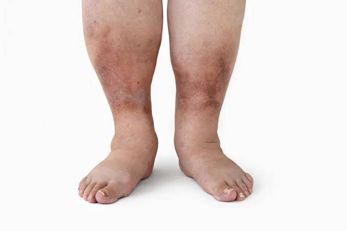When To See a Vascular Doctor for Leg Swelling
