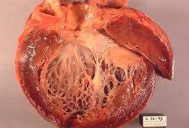 Image result for Cardiomyopathy