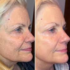 Microcurrent Facials San Diego