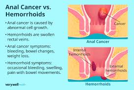 Image result for hemoroid human