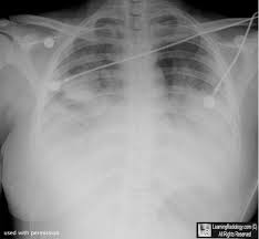 Please Click To Zoom Unzoom Heart Shadow Medical Help Signs Of Heart Failure