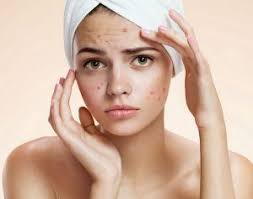 Image result for acne face