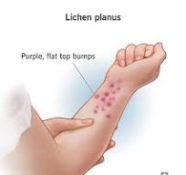 Lichen Planus: What It Is, Causes, Types & Treatments
