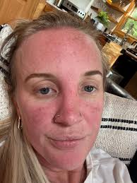 Travel tips for lupus sufferers?