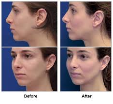 Technical And Clinical Considerations For Facial Feminization Surgery With Rhinoplasty And Related Procedures From Jama Facial Plastic Surgery Consejos